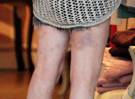 Los Lindsay  moretones en las piernas de  Lindsay Lohan  (FOTO)