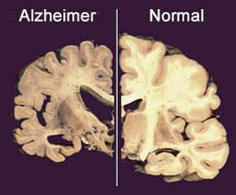 Cultivos 3D para entender el Alzheimer