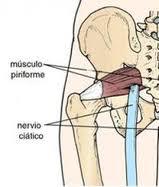 Quemazón en la parte alta del glúteo: Ciática o Síndrome Piramidal
