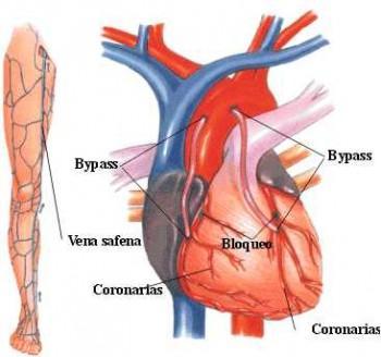 Los ex fumadores pueden tener complicaciones en cirugía de bypass Los ex fumadores pueden tener complicaciones en cirugía de bypass
