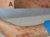 Vasculitis leucocitoclástica, alergia severa