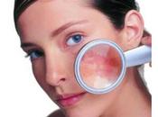 Manchas melanoma prevención mejor tratamiento