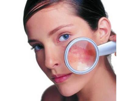 Manchas y melanoma - La prevención es el mejor tratamiento -