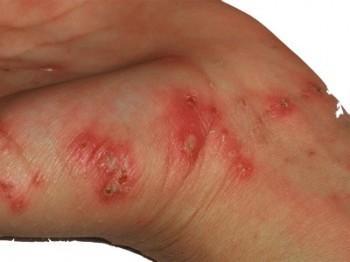 Principales formas de afección a nuestra salud por la sarna