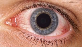 Los síntomas de ojo seco son comunes tras cirugía cosmética