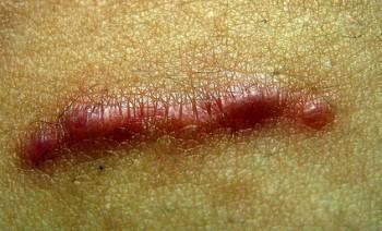 Consejos para la cicatrización de la herida quirúrgica Consejos para la cicatrización de la herida quirúrgica