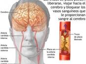 Angioplastias cerebrales para algunos pacientes accidente cerebrovascular