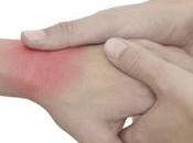 Consejos Para Calmar Artritis