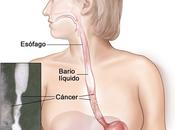 Cáncer Esofago