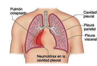 El neumotórax y sus formas de presentarse en el organismo