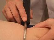 ¿Qué Fibrólisis Diacutánea?