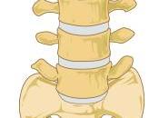 Comparacion riesgo fractura osteoporosis mujeres hombres