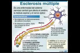 Disfrutar del Sexo a Pesar de la Esclerosis Múltiple