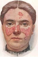 EL LUPUS Y EL DERMATÓLOGO