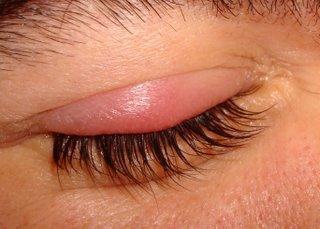 El orzuelo, una infección molesta en el párpado del ojo El orzuelo, una infección molesta en el párpado del ojo