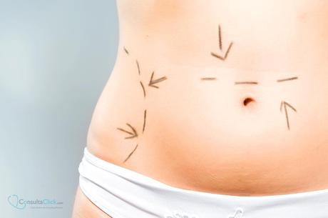 abdominoplastia flacidez ainhoa placer