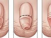 Circuncisión, como desarrolla complicaciones