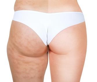 El alcohol favorece a la celulitis El alcohol favorece a la celulitis