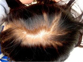 Excelentes resultados del microimplante capilar en la alopecia femenina