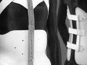 cura escoliosis corsé ortopédico?