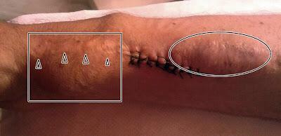 Memoria de mi Enfermera XLVII: «Con un golpe se me estropeó la Fístula»