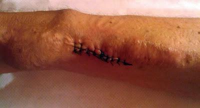 Memoria de mi Enfermera XLVII: «Con un golpe se me estropeó la Fístula»