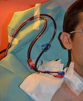 Memoria de mi Enfermera XLVII: «Con un golpe se me estropeó la Fístula»