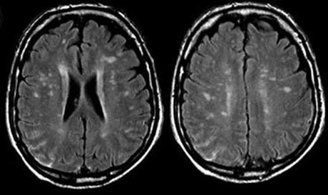 Neurosífilis: formas de presentación y manejo clínico