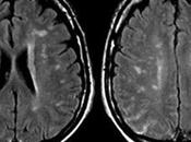 Neurosífilis: formas presentación manejo clínico