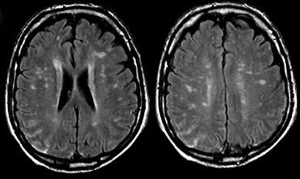 Neurosífilis: formas de presentación y manejo clínico