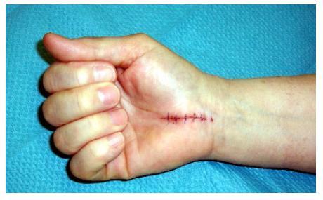 Sindrome tunel carpiano