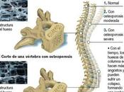 consumo excesivo alcohol promueve osteoporosis
