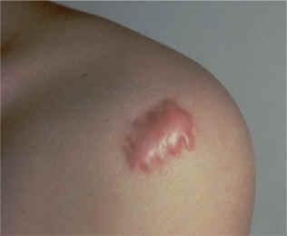 La Cicatrización Queloide