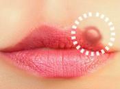 Novedades para Tratamiento Herpes Labial