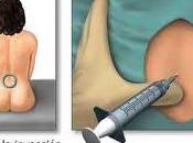 ¿Cómo parto anestesia epidural?