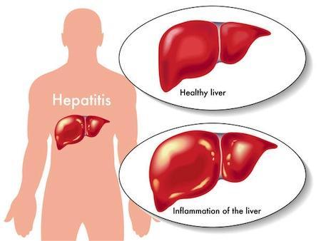 Alimentacion para personas que sufrieron de hepatitis