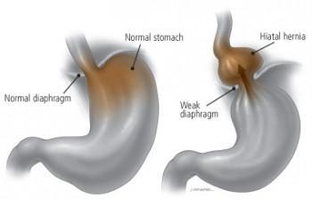 Dieta para pacientes con hernia de hiato