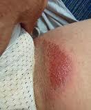 ¡Cura tus rozaduras axilares hoy!_2 Rozaduras en axilas_2