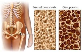 Consejos para controlar la osteopenia y el desarrollo de osteoporosis Consejos para controlar la osteopenia y el desarrollo de osteoporosis