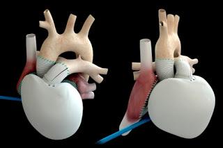 Llega el Corazón Artificial de Última Generación