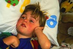 otitis de verano LA OTITIS EN VERANO