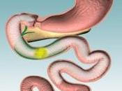 ¿Qué ENDOBARRIER? ¿Cómo funciona?