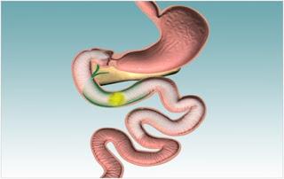 ¿Qué es el ENDOBARRIER? ¿Cómo funciona?