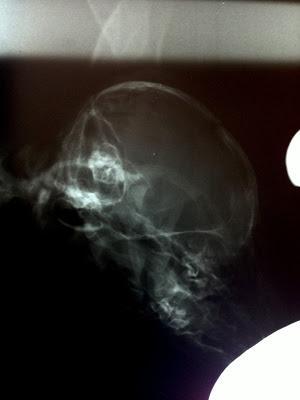 GALGA BEBÉ EN LA BASURA, CIEGA Y CON FRACTURA CRANEAL. (SEVILLA)