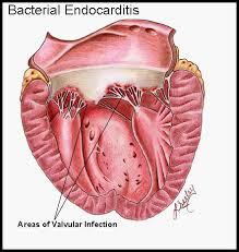 endocarditis