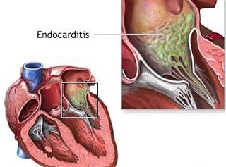 endocarditis
