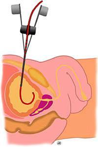 ¿Qué es la talla vesical o cistostomía?