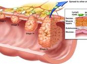 Recomendaciones para prevenir formación pólipos colon