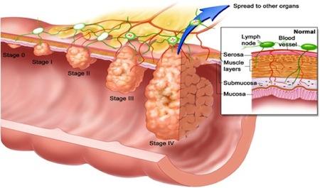 Recomendaciones para prevenir la formación de pólipos en el colon