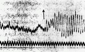 Historias de un Mito: Hans Berger. El inventor del Electroencefalograma